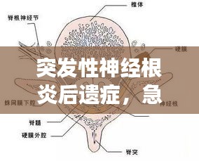 突發(fā)性神經(jīng)根炎后遺癥，急性根神經(jīng)炎 