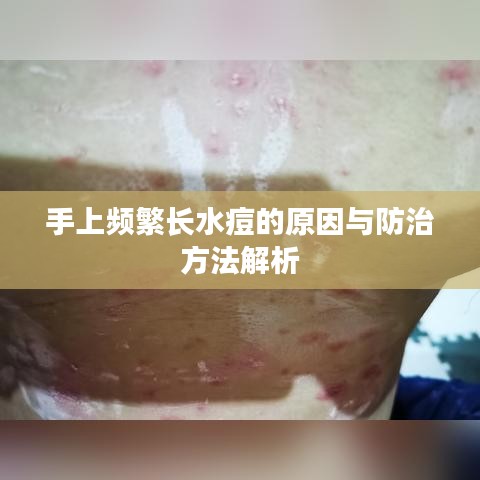 手上頻繁長水痘的原因與防治方法解析